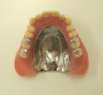 メタルブレードと総入れ歯の組み合わせ